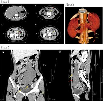 Wandering spleen combined with pedicle torsion and splenic infarction: a rare case report and literature review